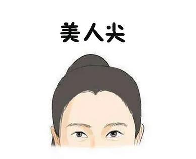 可以去掉美人尖吗?
